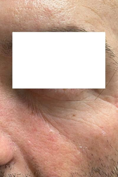 Eliminación de ojeras