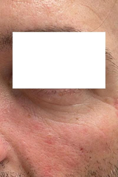 Eliminación de ojeras