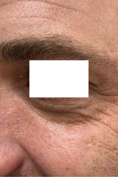 Eliminación de ojeras