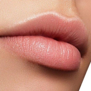 Resultados — Aumento de labios con ácido hialurónico