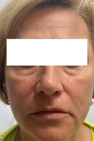 Eliminación de ojeras