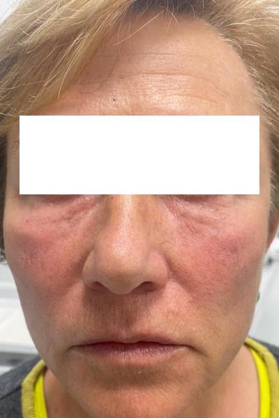 Eliminación de ojeras