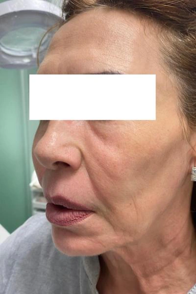 Antes — Flacidez facial 3 - Antes