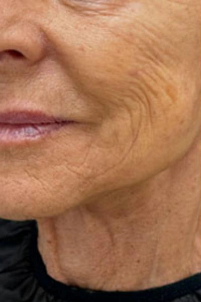 Antes — Skinbooster 1 - Antes