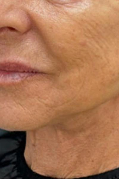 Después — Skinbooster 1 - Antes