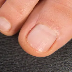 Procedimiento — Onicomicosis