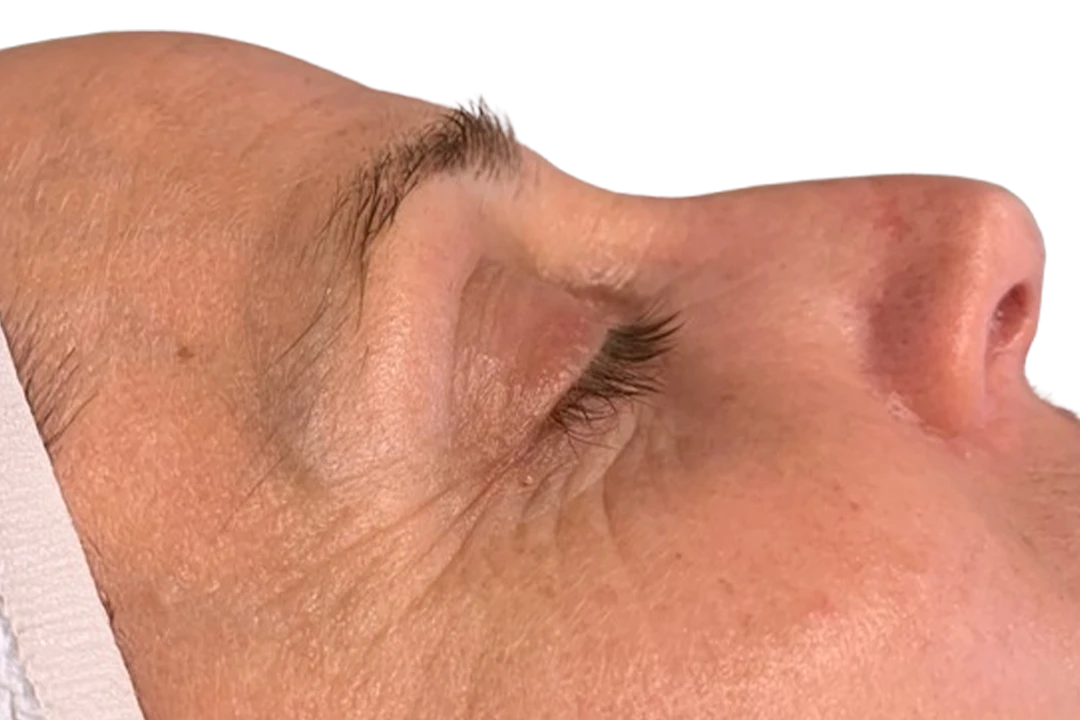Después — Dermapen 4 – Arrugas finas