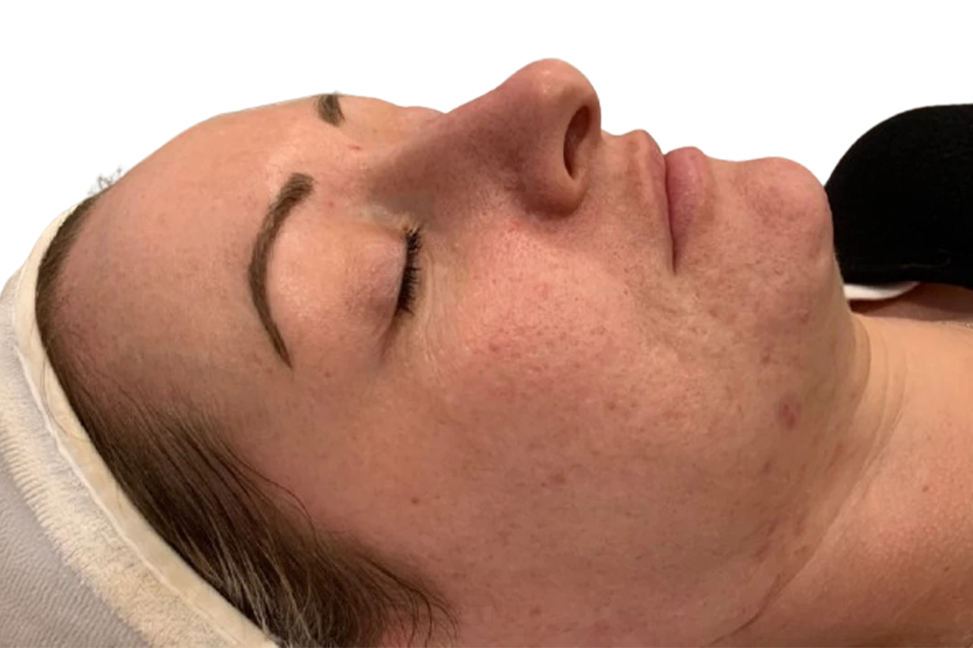 Antes — Dermapen 4 – Cicatrices
